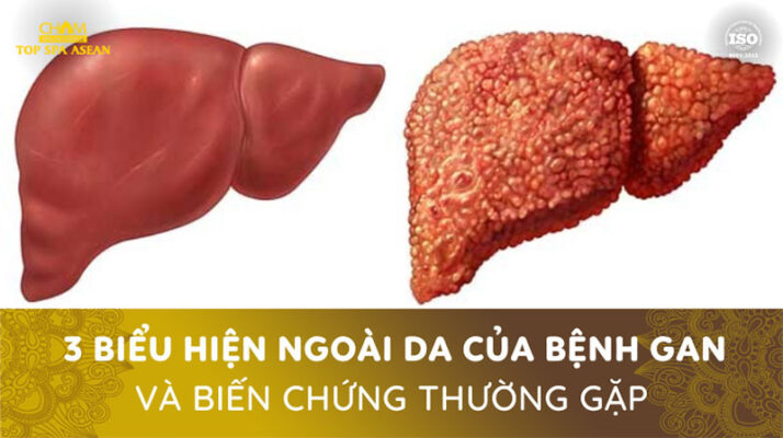 Biểu hiện ngoài da của bệnh gan Cham Spa & Massage