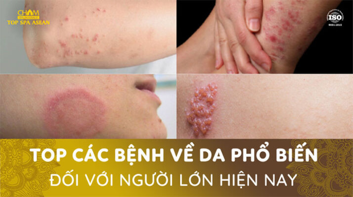 Các bệnh về da phổ biến ở người lớn Cham Spa & Massage