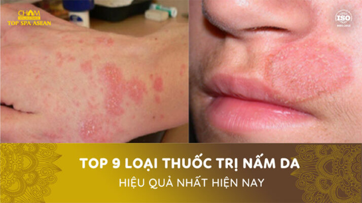 Top 9 loại thuốc trị nấm da hiệu quả Cham Spa & Massage