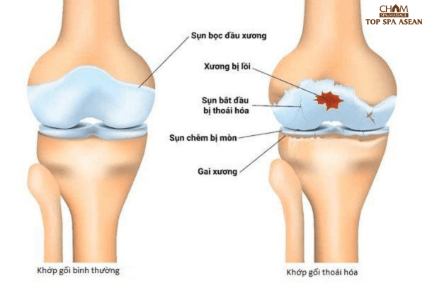 đau nhức xương khớp