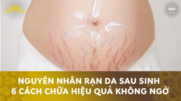 Chữa rạn da sau sinh Cham Spa & Massage