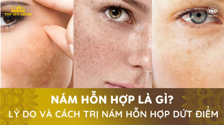 Cách trị nám hỗn hợp Cham Spa & Massage