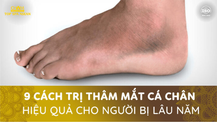 9 cách trị thâm mắt cá chân hiệu quả Cham Spa & Massage