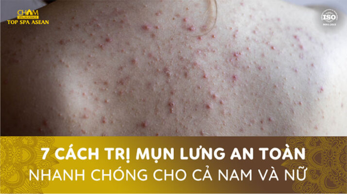 7 cách trị mụn lưng an toàn nhanh chóng cho cả nam và nữ