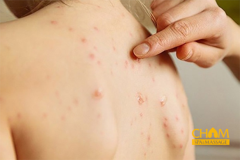 Các loại mụn lưng thường xuất hiện Cham Spa & Massage