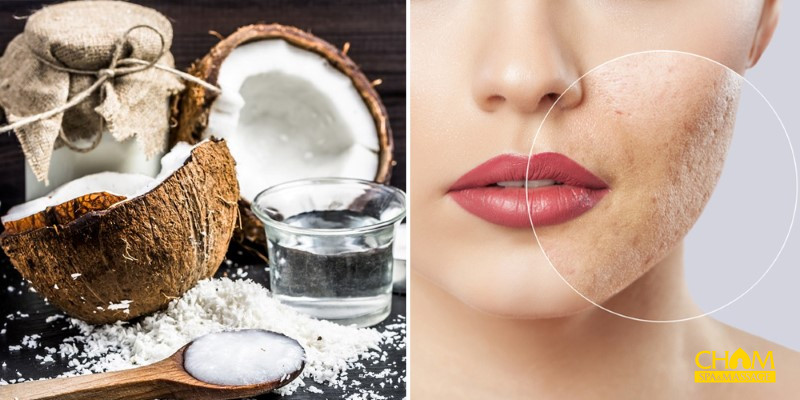 Cách hết mụn ẩn bằng dầu dừa