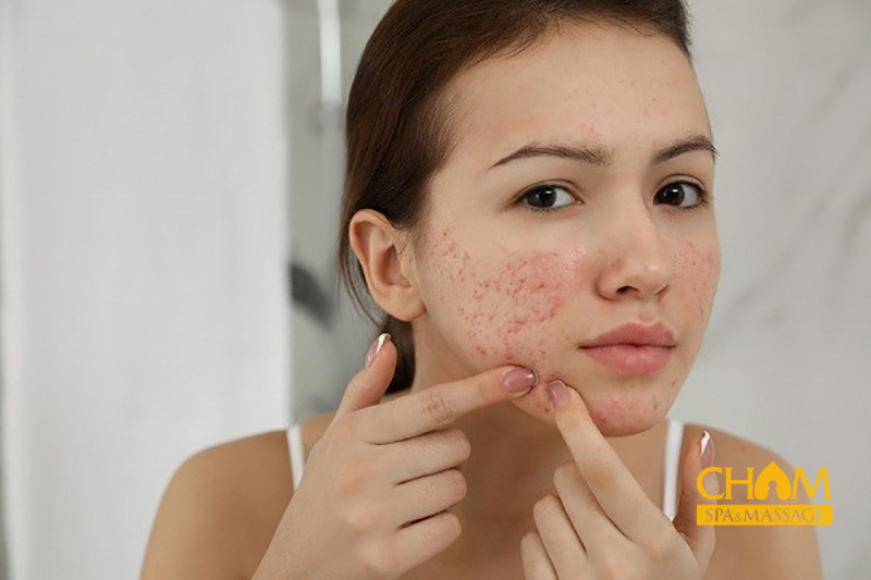 Lưu ý quan trọng khi điều trị mụn không phải ai cũng biết Cham Spa & Massage