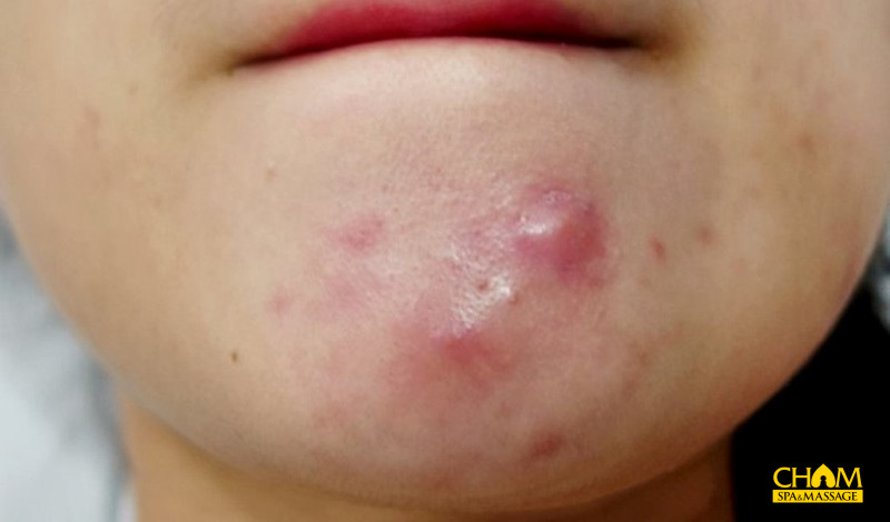 10 Cách trị mụn bọc an toàn tại nhà không để lại sẹo thâm da