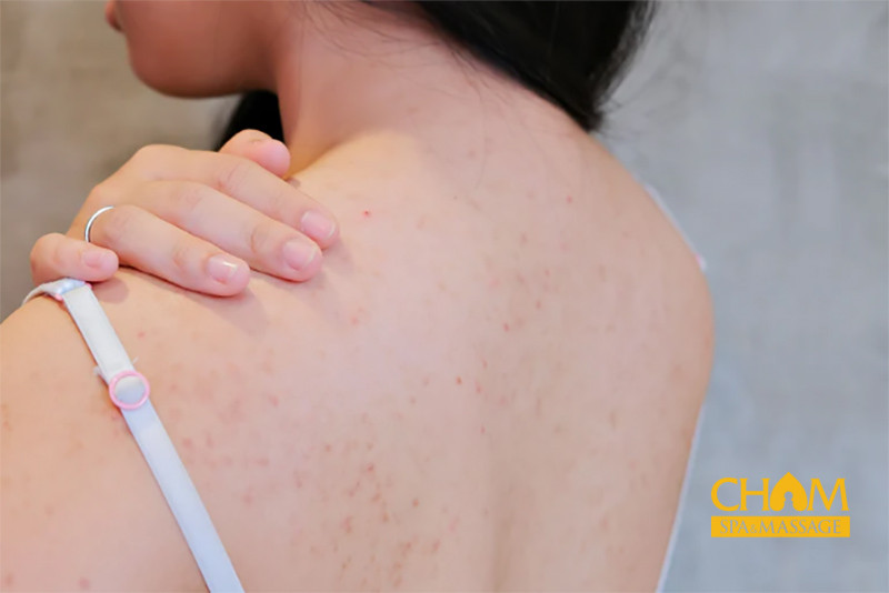 Sử dụng kem trị mụn lưng chuyên dụng Cham Spa & Massage
