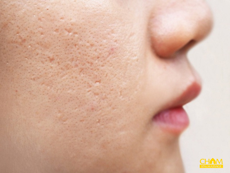 Top 10 cách điều trị sẹo rỗ hiệu quả không ngờ bạn nên thử
