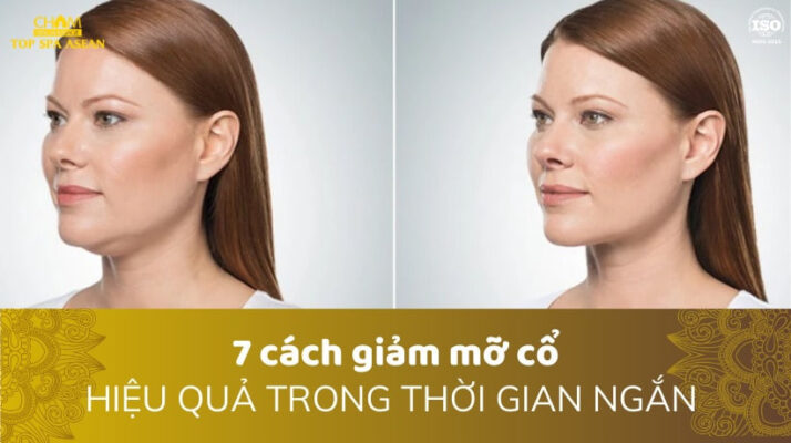 Giảm mỡ cổ