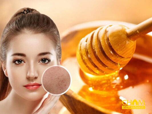 Chữa mụn ẩn hiệu quả với mật ong