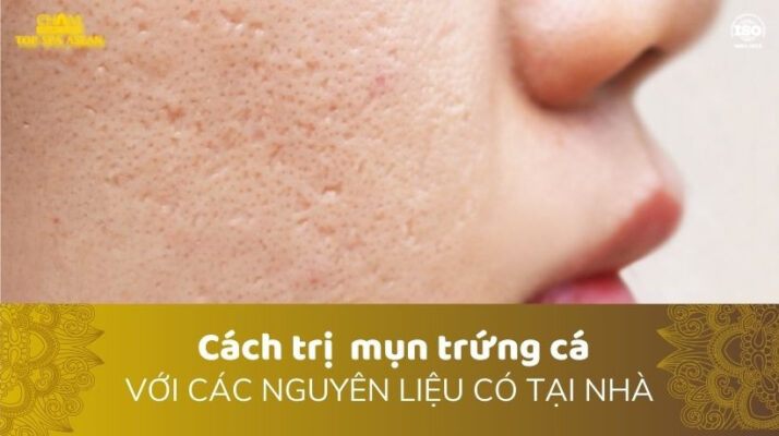 10 Cách trị mụn trứng cá từ nguyên liệu ở nhà hiệu quả cao