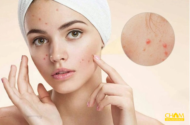 10 Cách trị mụn trứng cá từ nguyên liệu ở nhà hiệu quả cao
