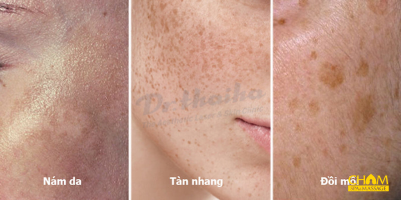 Cách trị tàn nhang