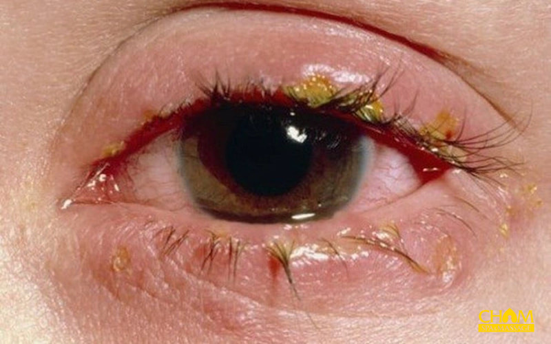 Cách trị đau mắt đỏ tại nhà