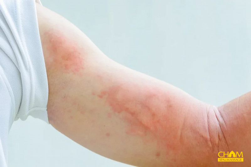 cách trị mề đay