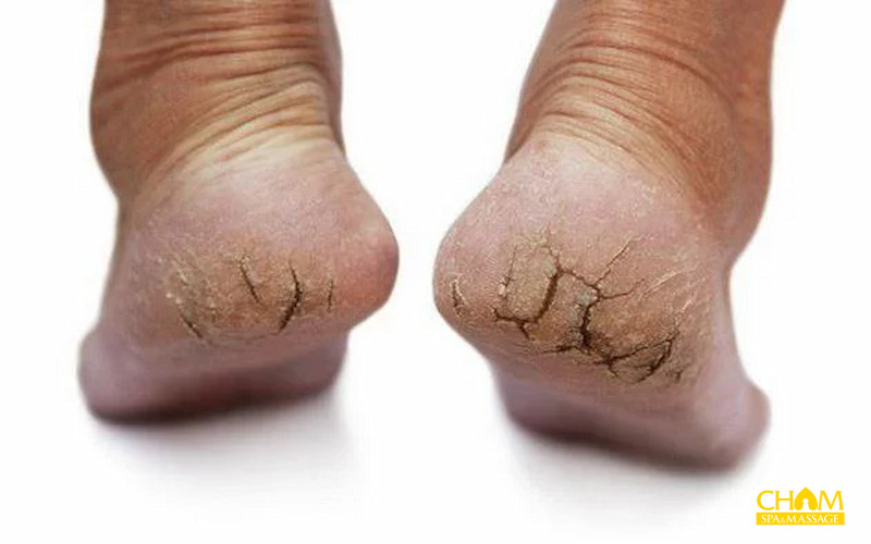 Cách trị nứt gót chân