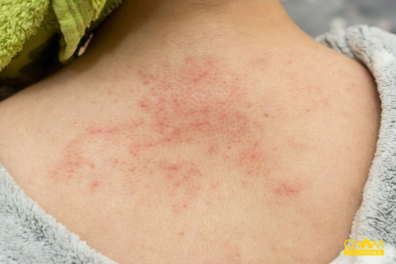 cách trị viêm nang lông