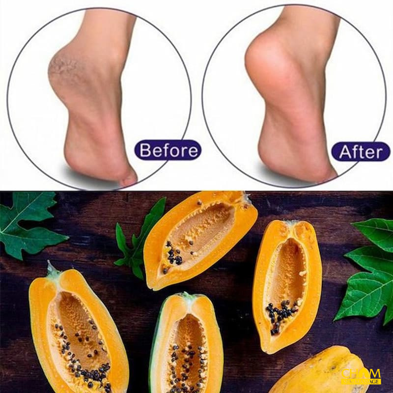 Cách trị nứt gót chân