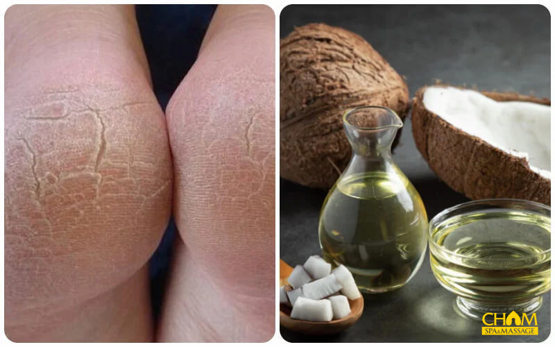 Cách trị nứt gót chân
