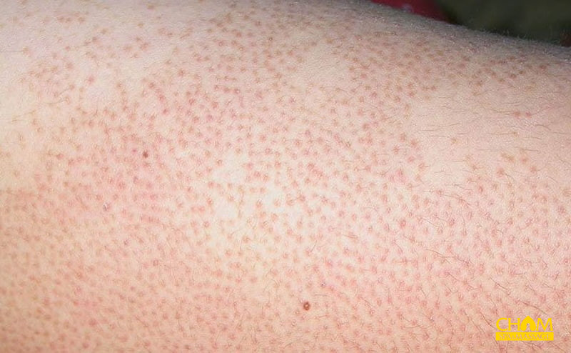 cách trị viêm nang lông