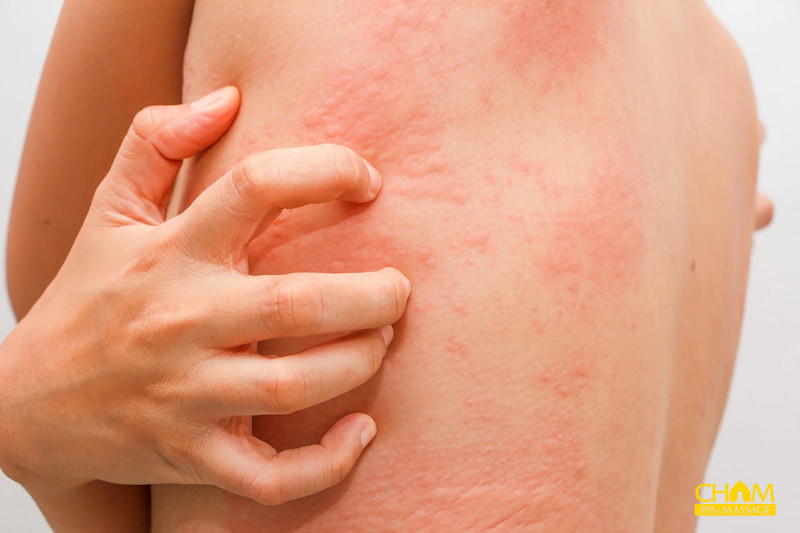 cách trị mề đay